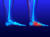 When to Visit the Doctor for Flat Feet